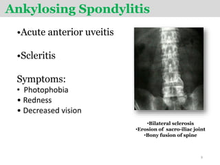 Ankylosing Spondylitis
•Acute anterior uveitis
•Scleritis
Symptoms:
• Photophobia
• Redness
• Decreased vision
•Bilateral sclerosis
•Erosion of sacro-iliac joint
•Bony fusion of spine
9
 