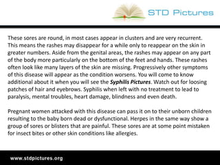 The #1 resource for STD pictures and photos | PPTX