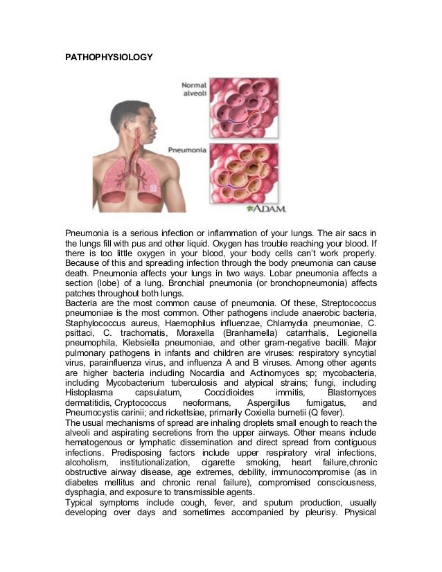 case study on pneumonia