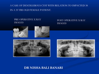 PRE OPERATIVE X RAY
IMAGES
POST OPERATIVE X RAY
IMAGES
A CASE OF DENTIGEROUS CYST WITH RELATION TO IMPACTED 38
IN A 35 YRS OLD FEMALE PATIENT.
DR NISHA BALI BANARI
 