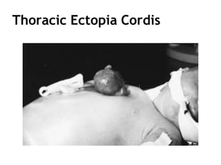 Thoracic Ectopia Cordis
 