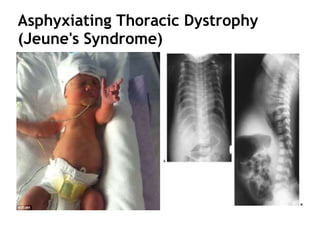 Asphyxiating Thoracic Dystrophy
(Jeune's Syndrome)
 