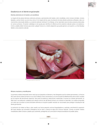 CIRUGIA BUCAL PARA PREGRADO Y EL ODONTÓLOGO GENERAL
CIRUGIABUCALPARAPREGRADOYELODONTÓLOGOGENERAL
427
Exodoncia en el diente erupcionado:
Dientes anteriores en el maxilar y la mandíbula
La mayoría de las piezas dentarias anteriores primarias y permanentes del maxilar y de la mandíbula, como incisivos centrales, incisivos
laterales y caninos tienen una raíz única cónica. En la mayoría de los casos, la extracción de estos dientes anteriores es llevada a cabo con
movimientos rotacionales debido a su anatomía radicular individual. Sin embargo, se han reportado casos de raíces accesorias observadas
en caninos primarios. El examen radiológico es de ayuda para identificar la diferencia de la anatomía radicular previo a la exodoncia.
Ciertos cuidados deben tomarse para evitar cualquier fuerza en un diente adyacente que pueda generar una luxación o un fácil desalojo
debido a esta anatomía radicular.
Molares maxilares y mandibulares
Los primeros molares temporales tienen raíces que son pequeñas en diámetro y más divergentes que los molares permanentes. La fractura
de la raíces de los molares primarios no es común debido a estas características, así como el potencial debilitamiento de las raíces causadas
por la erupción del permanente respectivo. Para evitar la exodoncia, dislocaciones inadvertidas o traumas en el diente permanente, se
debe hacer una evaluación cuidadosa de la relación entre la raíz del diente primario con el diente en desarrollo. Los molares temporales
con raíces que circundan la corona del diente definitivo en erupción pueden necesitar ser seccionados para proteger la localización del
diente permanente.
La extracción de molares se lleva a cabo usando una fuerza pequeña continua lingual/palatina y vestibular, permitiendo la expansión
del hueso alveolar que acomode la divergencia de las raíces y reduzca el riego de la fractura radicular. Cuando se extraen molares
mandibulares deben tomarse cuidados para sostenerla, protegiendo así la articulación témporomandibular de posibles daños.
Drenaje de absceso submucoso.
 