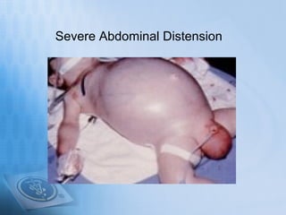 Severe Abdominal Distension
 