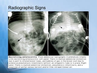 Radiographic Signs
 
