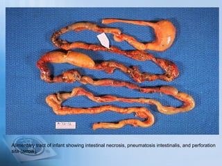 Alimentary tract of infant showing intestinal necrosis, pneumatosis intestinalis, and perforation
site (arrow).
 