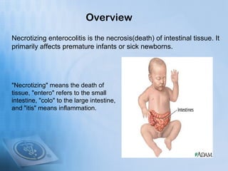 Overview
Necrotizing enterocolitis is the necrosis(death) of intestinal tissue. It
primarily affects premature infants or ...