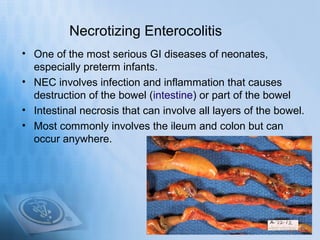 Necrotizing Enterocolitis
• One of the most serious GI diseases of neonates,
  especially preterm infants.
• NEC involves infection and inflammation that causes
  destruction of the bowel (intestine) or part of the bowel
• Intestinal necrosis that can involve all layers of the bowel.
• Most commonly involves the ileum and colon but can
  occur anywhere.
 
