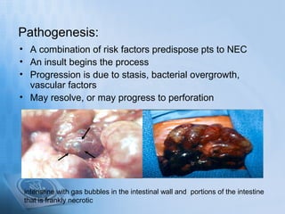 Pathogenesis:
• A combination of risk factors predispose pts to NEC
• An insult begins the process
• Progression is due to stasis, bacterial overgrowth,
  vascular factors
• May resolve, or may progress to perforation




 intenstine with gas bubbles in the intestinal wall and portions of the intestine
 that is frankly necrotic
 