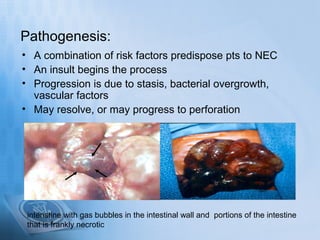 Pathogenesis:
• A combination of risk factors predispose pts to NEC
• An insult begins the process
• Progression is due to...