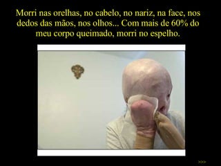 Morri nas orelhas, no cabelo, no nariz, na face, nos dedos das mãos, nos olhos... Com mais de 60% do meu corpo queimado, morri no espelho. >>> 