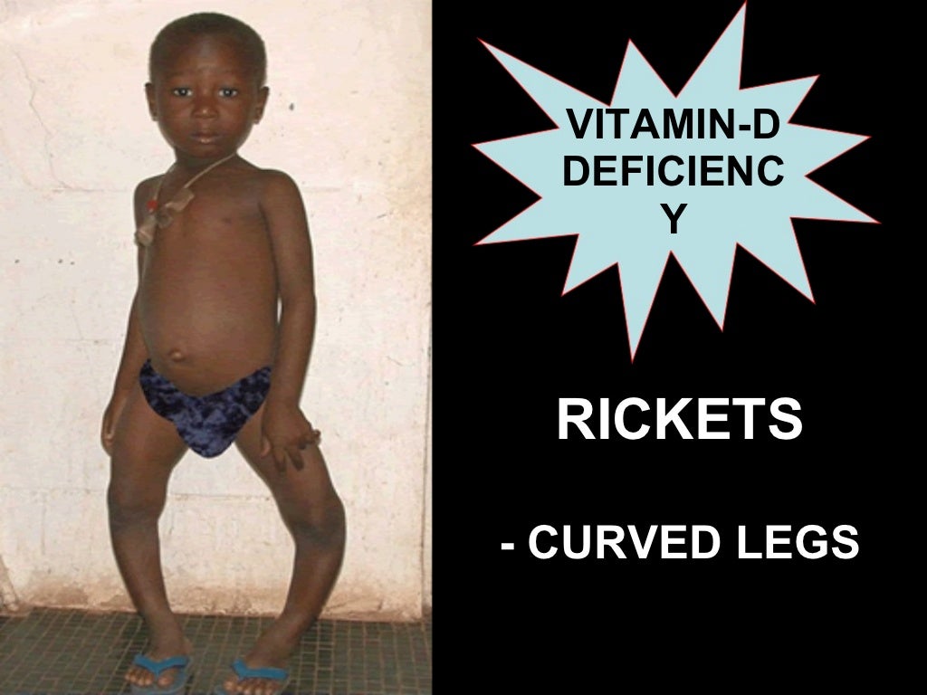 DEFICIENCY DISEASES deficiency-diseases