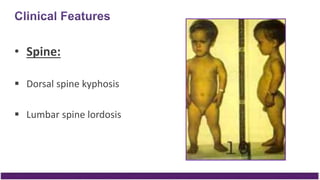 • Spine:
 Dorsal spine kyphosis
 Lumbar spine lordosis
 