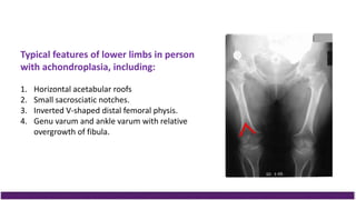 Typical features of lower limbs in person
with achondroplasia, including:
1. Horizontal acetabular roofs
2. Small sacrosciatic notches.
3. Inverted V-shaped distal femoral physis.
4. Genu varum and ankle varum with relative
overgrowth of fibula.
 