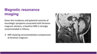 Magnetic resonance
imaging
Given the incidence and potential severity of
neurologic symptoms associated with foramen
magnum stenosis, a baseline MRI is strongly
recommended in infancy.
 MRI showing cervicomedullary compression
at foramen magnum.
 