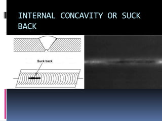 INTERNAL CONCAVITY OR SUCK
BACK
 
