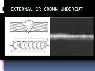 EXTERNAL OR CROWN UNDERCUT
 