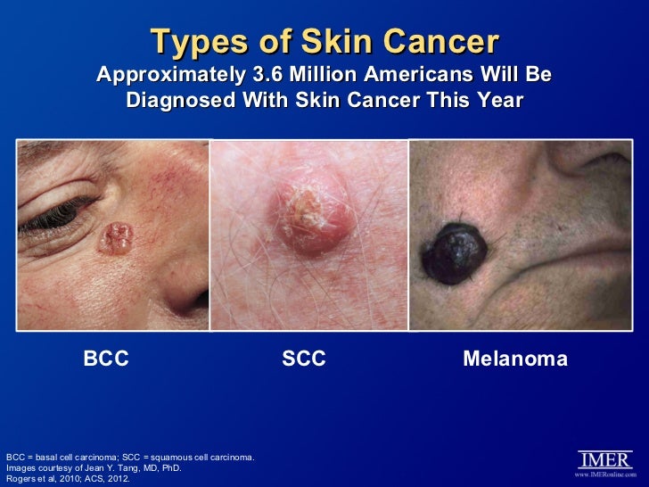 Basal Cell Carcinoma Vs Malignant Melanoma