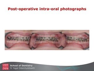 School of Dentistry
Yr Ysgol Ddeintyddiaeth
Post-operative intra-oral photographs
 