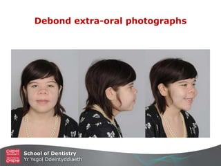 School of Dentistry
Yr Ysgol Ddeintyddiaeth
Debond extra-oral photographs
 
