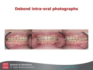 School of Dentistry
Yr Ysgol Ddeintyddiaeth
Debond intra-oral photographs
 