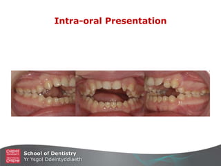 School of Dentistry
Yr Ysgol Ddeintyddiaeth
Intra-oral Presentation
 