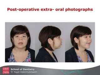 School of Dentistry
Yr Ysgol Ddeintyddiaeth
Post-operative extra- oral photographs
 