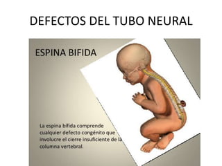 DEFECTOS DEL TUBO NEURAL
 