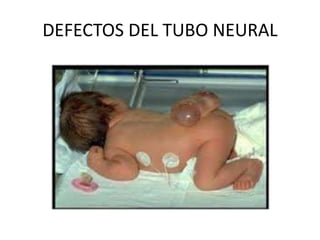 DEFECTOS DEL TUBO NEURAL
 