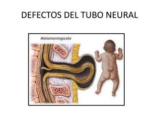 DEFECTOS DEL TUBO NEURAL
 
