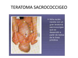 TERATOMA SACROCOCCIGEO
 