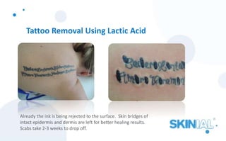 Tattoo Removal Using Lactic Acid
Already the ink is being rejected to the surface. Skin bridges of
intact epidermis and dermis are left for better healing results.
Scabs take 2-3 weeks to drop off.
 