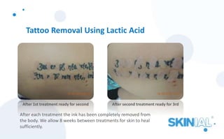 Tattoo Removal Using Lactic Acid
After each treatment the ink has been completely removed from
the body. We allow 8 weeks between treatments for skin to heal
sufficiently.
After 1st treatment ready for second After second treatment ready for 3rd
 