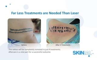 Far Less Treatments are Needed Than Laser
This tattoo will be completely removed in just 4 treatments.
Aftercare is a vital part for a successful outcome.
Before After 3 Treatments
 