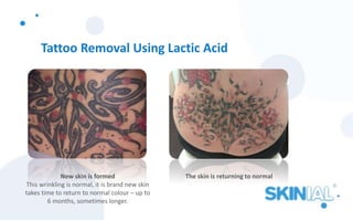 Tattoo Removal Using Lactic Acid
New skin is formed
This wrinkling is normal, it is brand new skin
takes time to return to normal colour – up to
6 months, sometimes longer.
The skin is returning to normal
 