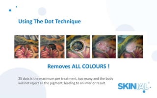 Using The Dot Technique
25 dots is the maximum per treatment, too many and the body
will not reject all the pigment, leading to an inferior result.
Removes ALL COLOURS !
 