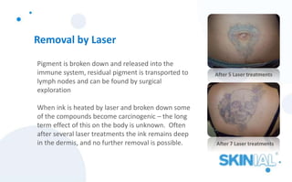 Removal by Laser
Pigment is broken down and released into the
immune system, residual pigment is transported to
lymph nodes and can be found by surgical
exploration
When ink is heated by laser and broken down some
of the compounds become carcinogenic – the long
term effect of this on the body is unknown. Often
after several laser treatments the ink remains deep
in the dermis, and no further removal is possible.
After 5 Laser treatments
After 7 Laser treatments
 