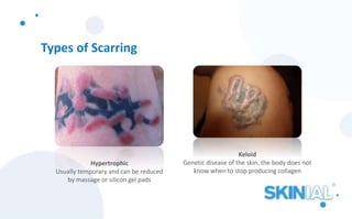 Types of Scarring
Hypertrophic
Usually temporary and can be reduced
by massage or silicon gel pads
Keloid
Genetic disease of the skin, the body does not
know when to stop producing collagen
 