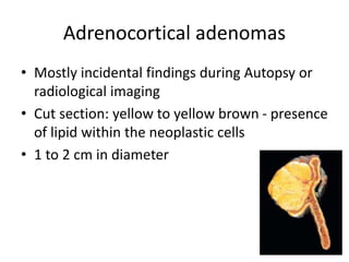 Adrenocortical adenomas
• Mostly incidental findings during Autopsy or
radiological imaging
• Cut section: yellow to yellow brown - presence
of lipid within the neoplastic cells
• 1 to 2 cm in diameter
 