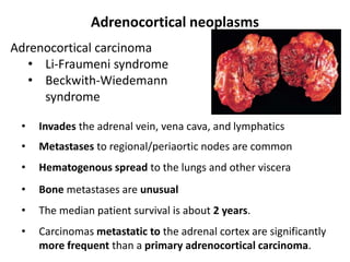 Adrenocortical neoplasms
Adrenocortical carcinoma
• Li-Fraumeni syndrome
• Beckwith-Wiedemann
syndrome
• Invades the adrenal vein, vena cava, and lymphatics
• Metastases to regional/periaortic nodes are common
• Hematogenous spread to the lungs and other viscera
• Bone metastases are unusual
• The median patient survival is about 2 years.
• Carcinomas metastatic to the adrenal cortex are significantly
more frequent than a primary adrenocortical carcinoma.
 