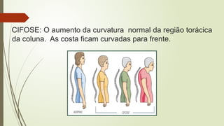 CIFOSE: O aumento da curvatura normal da região torácica
da coluna. As costa ficam curvadas para frente.
 