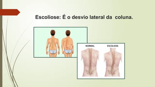 Escoliose: É o desvio lateral da coluna.
 