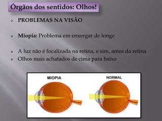  PROBLEMAS NA VISÃO
 Miopia: Problema em enxergar de longe
 A luz não é focalizada na retina, e sim, antes da retina
 Olhos mais achatados de cima para baixo
Órgãos dos sentidos: Olhos!
 