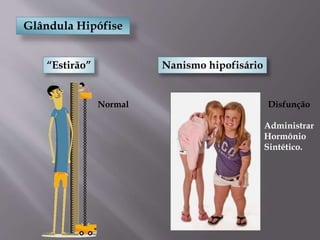 Glândula Hipófise
“Estirão” Nanismo hipofisário
Disfunção
Administrar
Hormônio
Sintético.
Normal
 