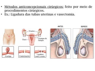 • Métodos anticoncepcionais cirúrgicos: feito por meio de
procedimentos cirúrgicos.
• Ex.: Ligadura das tubas uterinas e vasectomia.
 
