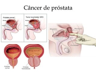 Câncer de próstata
 