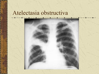 Atelectasia obstructiva