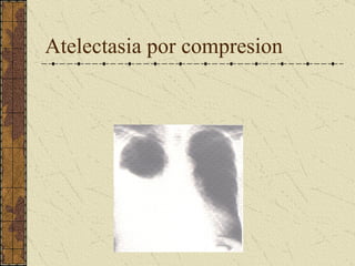 Atelectasia por compresion