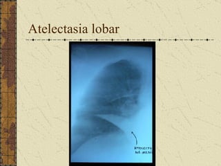 Atelectasia lobar
