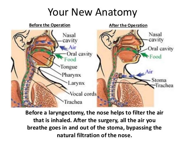 laryngectomy 1 1 laryngectomy
